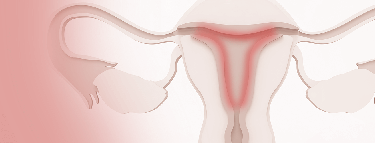 Endometrite: o que é?